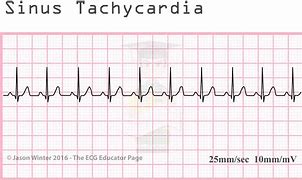 Resultado de imagen de taquicardia sinusal ecg