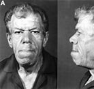 Resultado de imagen de acromegalia.gif